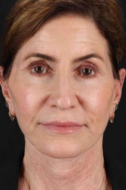 Neck Lift Before & After Patient #2452