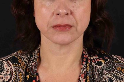 Neck Lift Before & After Patient #2472
