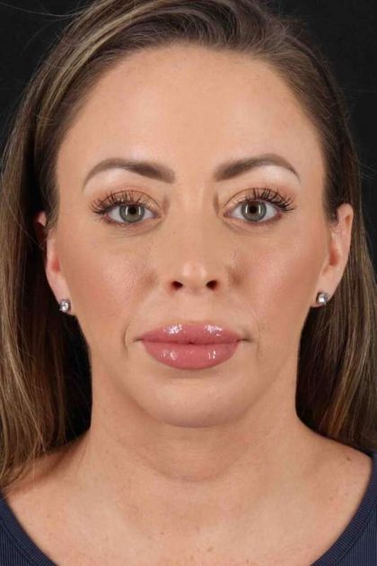 Neck Lift Before & After Patient #2505