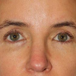 Browlift Before & After Patient #1373