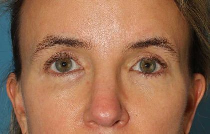 Browlift Before & After Patient #1373