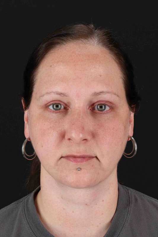 Neck Lift Before & After Patient #2527