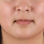 Neck Lift Before & After Patient #2549