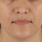 Neck Lift Before & After Patient #2560