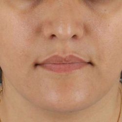Neck Lift Before & After Patient #2560