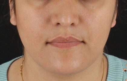 Neck Lift Before & After Patient #2560