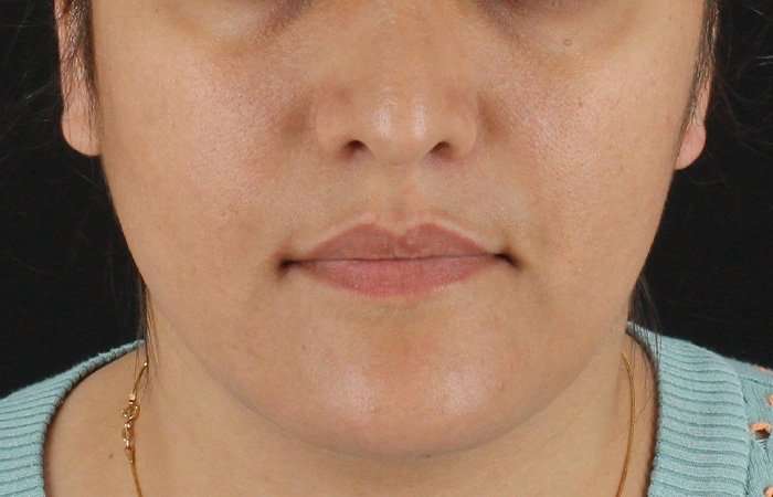 Neck Lift Before & After Patient #2560
