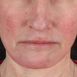 Neck Lift Before & After Patient #2571