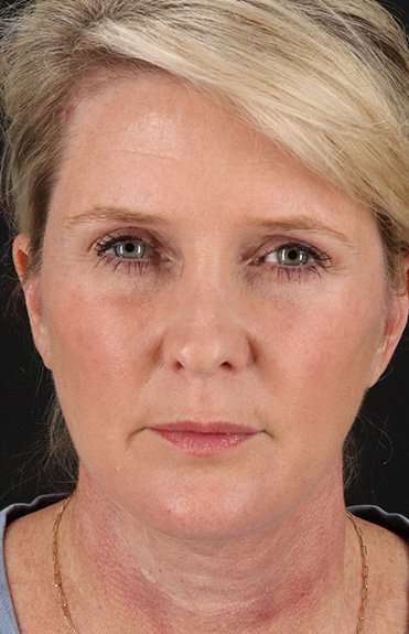 Neck Lift Before & After Patient #2582