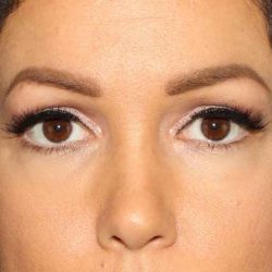 Browlift Before & After Patient #1384