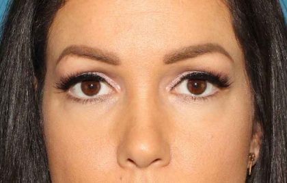 Browlift Before & After Patient #1384