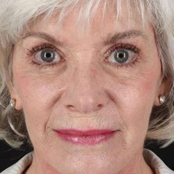 Neck Lift Before & After Patient #2637