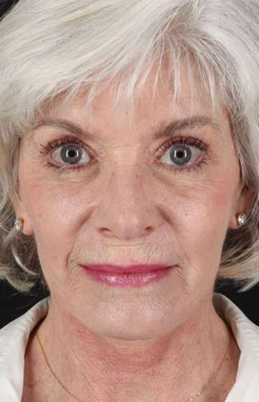Neck Lift Before & After Patient #2637