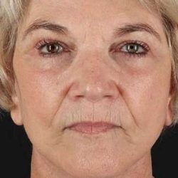 Neck Lift Before & After Patient #2648