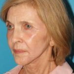 Neck Lift Before & After Patient #2664
