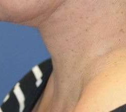 Neck Lift Before & After Patient #2667