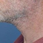 Neck Lift Before & After Patient #2673