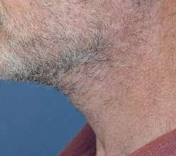 Neck Lift Before & After Patient #2673
