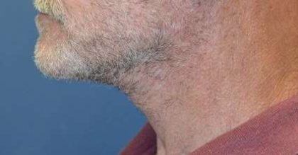 Neck Lift Before & After Patient #2673