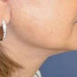 Neck Lift Before & After Patient #2683
