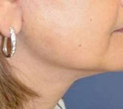 Neck Lift Before & After Patient #2683