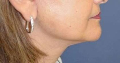 Neck Lift Before & After Patient #2683