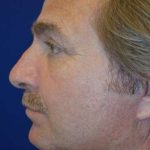 Neck Lift Before & After Patient #2686