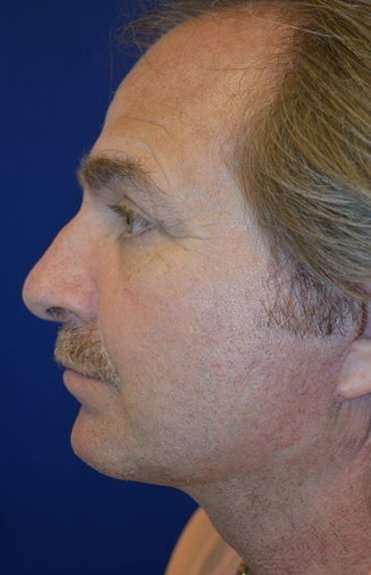Neck Lift Before & After Patient #2686
