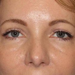 Browlift Before & After Patient #1391