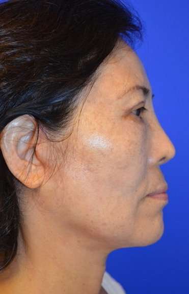 Neck Lift Before & After Patient #2689