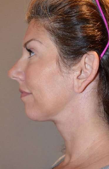 Neck Lift Before & After Patient #2692