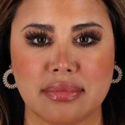 Neck Liposuction Before & After Patient #2708