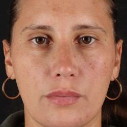 Neck Liposuction Before & After Patient #2719