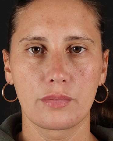 Neck Liposuction Before & After Patient #2719