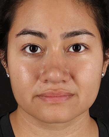 Neck Liposuction Before & After Patient #2730