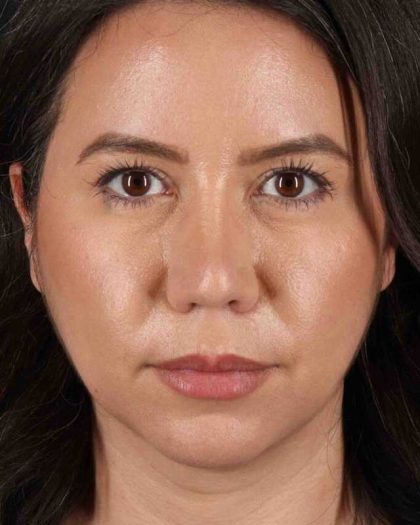 Neck Liposuction Before & After Patient #2741