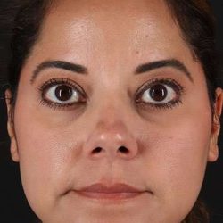 Neck Liposuction Before & After Patient #2752