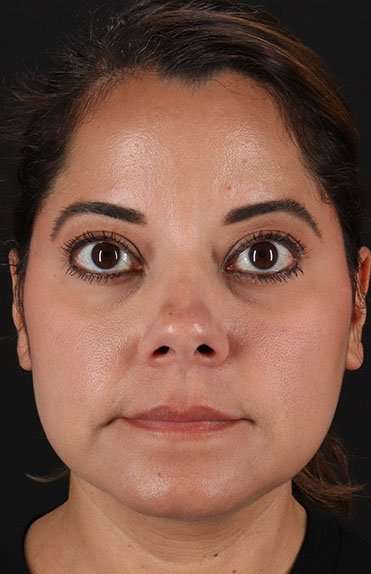 Neck Liposuction Before & After Patient #2752