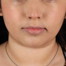 Neck Liposuction Before & After Patient #2774