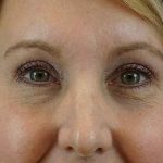 Browlift Before & After Patient #1402