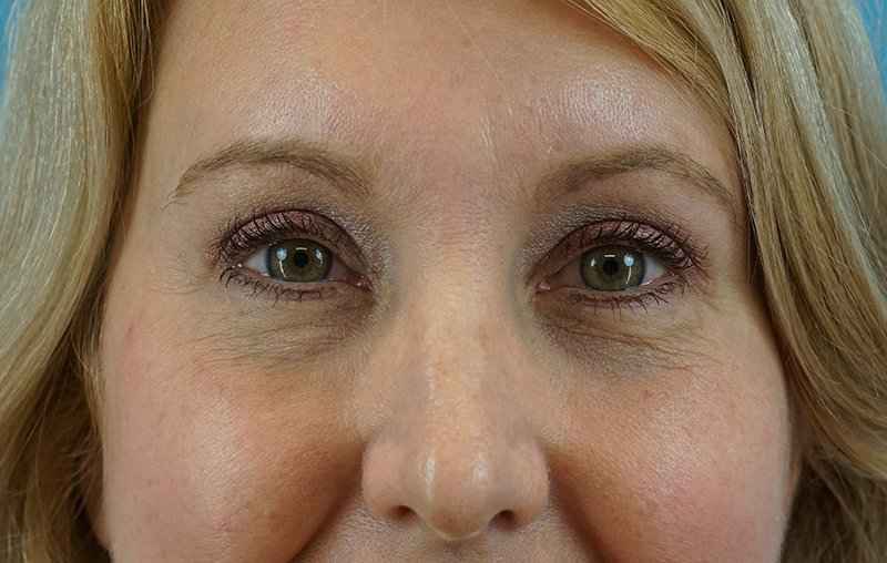 Browlift Before & After Patient #1402