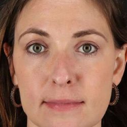 Neck Liposuction Before & After Patient #2785