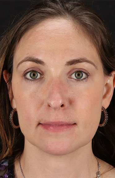 Neck Liposuction Before & After Patient #2785