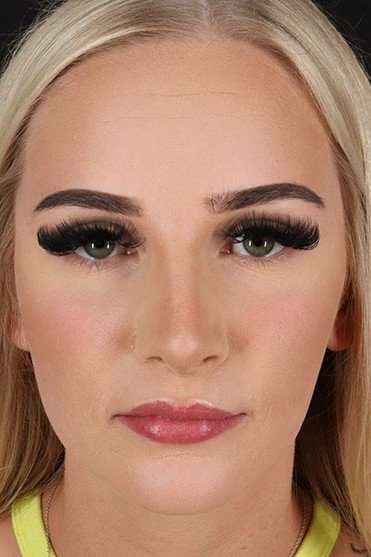 Rhinoplasty Before & After Patient #2807