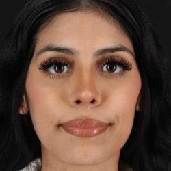 Rhinoplasty Before & After Patient #2818