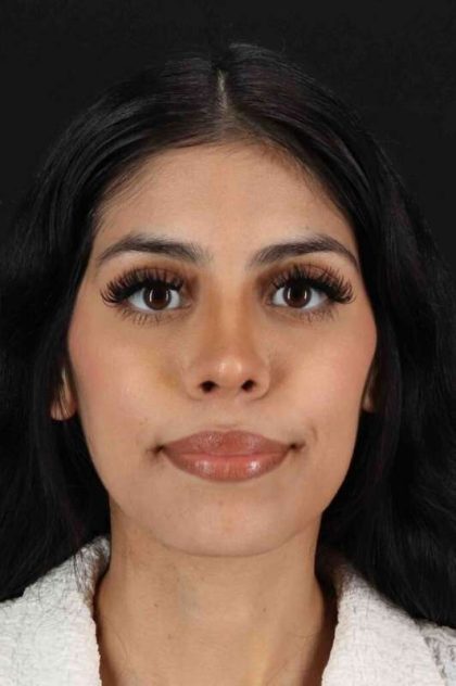 Rhinoplasty Before & After Patient #2818