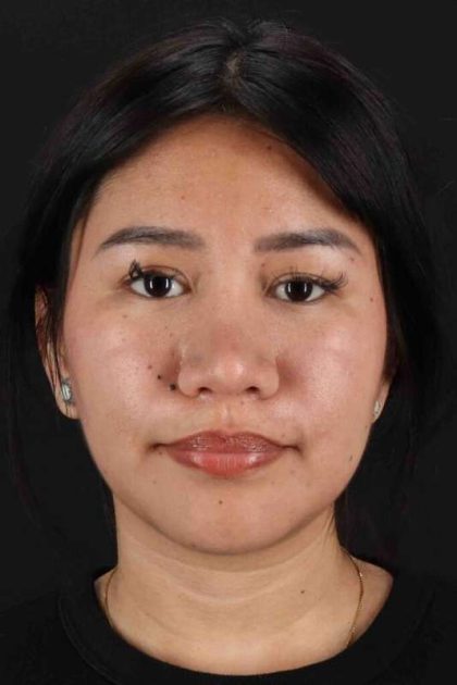 Rhinoplasty Before & After Patient #2829