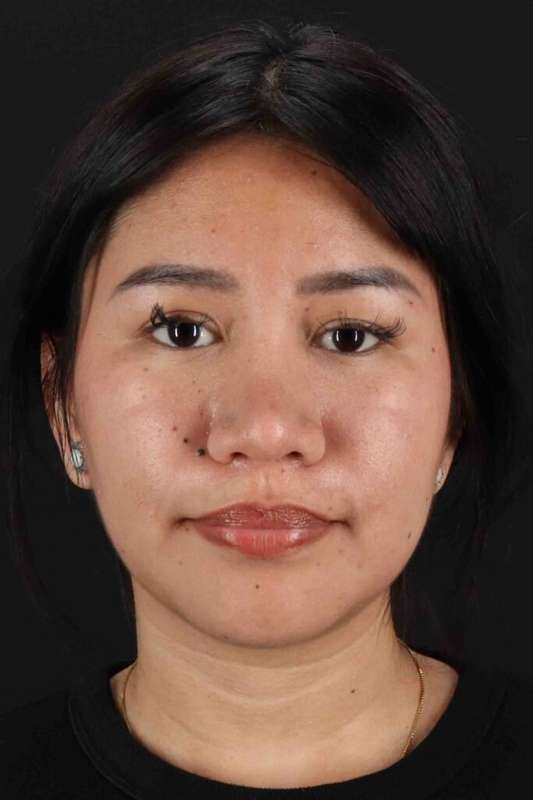 Rhinoplasty Before & After Patient #2829