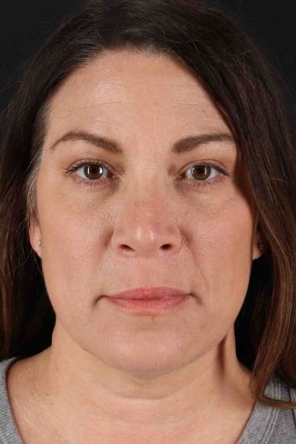 Rhinoplasty Before & After Patient #2851
