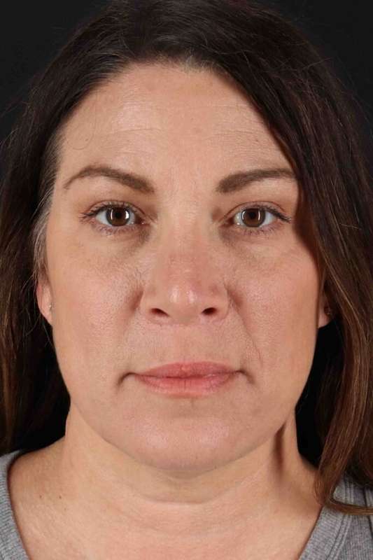 Rhinoplasty Before & After Patient #2851